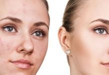 Acné: cuáles son las causas y los tratamientos que recomiendan los expertos para curarlo