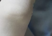 Extraen cuerpo extraño de una niña con problemas respiratorios