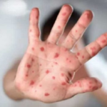 Viruela del mono: Argentina confirmó su primer caso autóctono