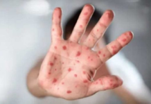 Viruela del mono: Argentina confirmó su primer caso autóctono