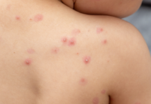 OMS declaró emergencia de salud internacional por viruela de mono