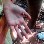 Terrible: rescataron a niña de 7 años infectada de piques, está hospitalizada