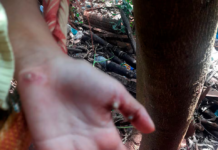 Terrible: rescataron a niña de 7 años infectada de piques, está hospitalizada