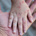 Alerta por Sarampión: instan a la vacunación para evitar brotes