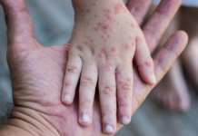 Alerta por Sarampión: instan a la vacunación para evitar brotes