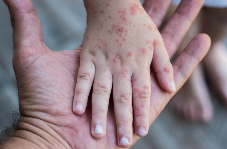 Alerta por Sarampión: instan a la vacunación para evitar brotes Alerta por Sarampión: instan a la vacunación para evitar brotes