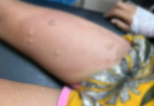 Imputan a hombre que derramó comida caliente a su hijastra de 6 años