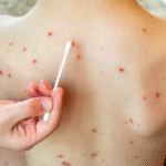 Salud activa alerta tras la confirmación de un caso de sarampión