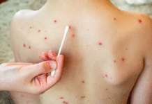 Salud activa alerta tras la confirmación de un caso de sarampión