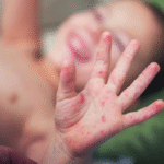 Paraguay detecta tres nuevos casos de sarampión