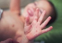 Paraguay detecta tres nuevos casos de sarampión