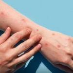 Confirman viruela del mono en Foz de Yguazú: paciente estaría residiendo en CDE