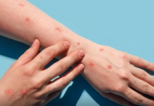 Confirman viruela del mono en Foz de Yguazú: paciente estaría residiendo en CDE