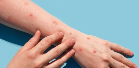 Confirman viruela del mono en Foz de Yguazú: paciente estaría residiendo en CDE